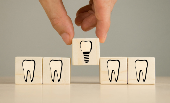 Why Are Dental Implants Becoming So Popular Today?