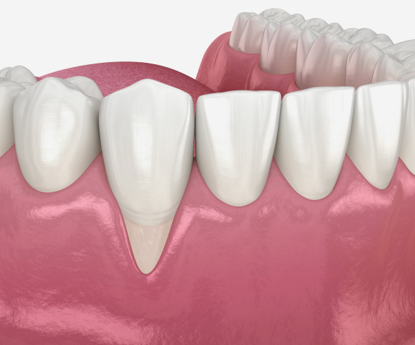 “Why Do My Teeth Hurt When I Drink Cold Water?”