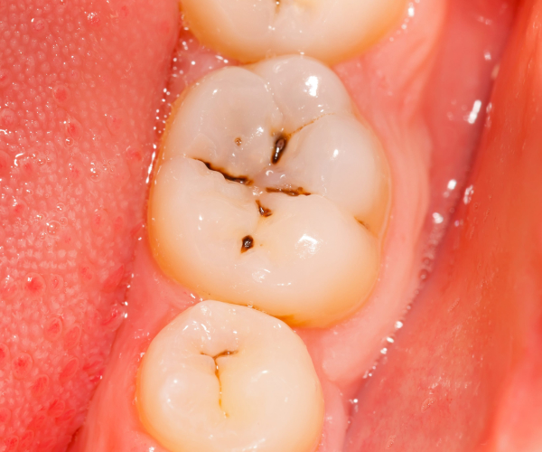 “Why Do My Teeth Hurt When I Drink Cold Water?”