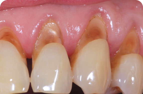 DENTAL ABRASION