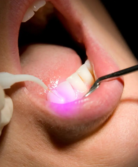 Diode Laser Diode Laser