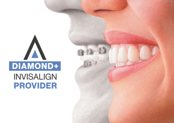 Invisalign