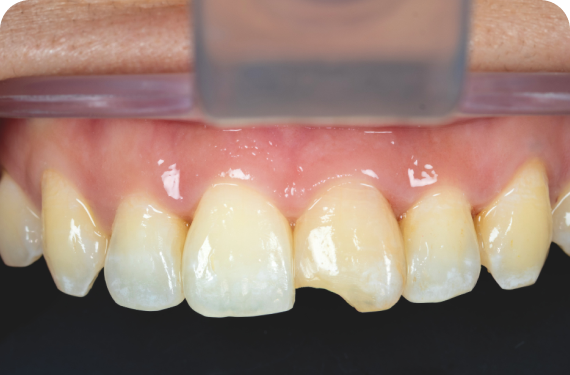 FRACTURED TEETH