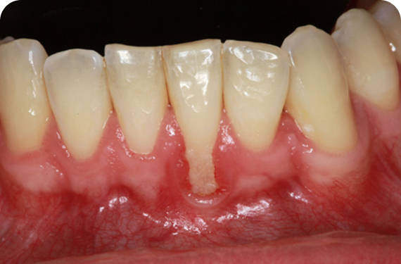 GUM RECESSION