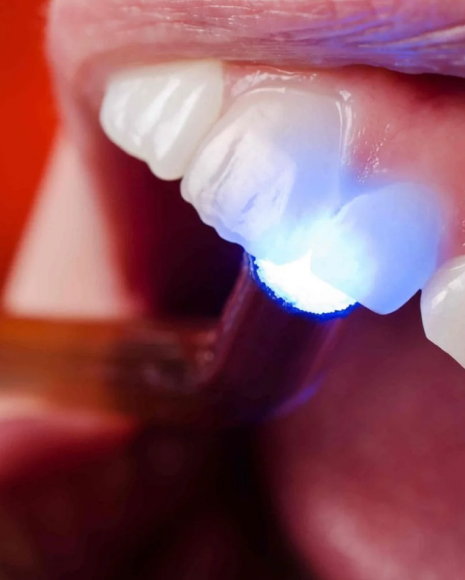 Aesthetic Filling Aesthetic Filling