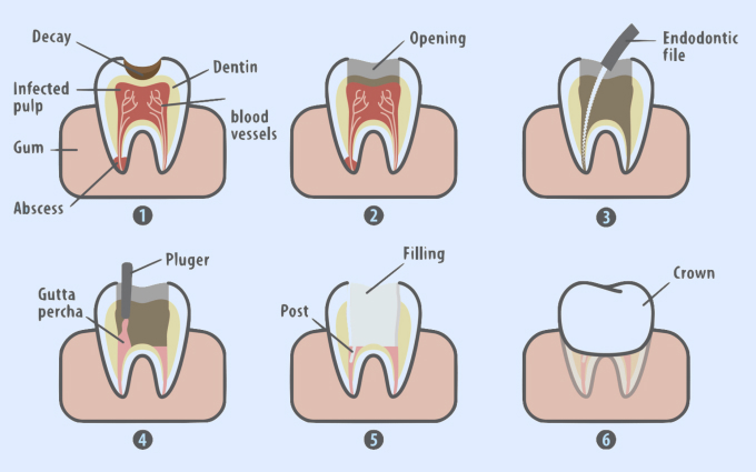 Dental Crown for Root Canal Treated Teeth