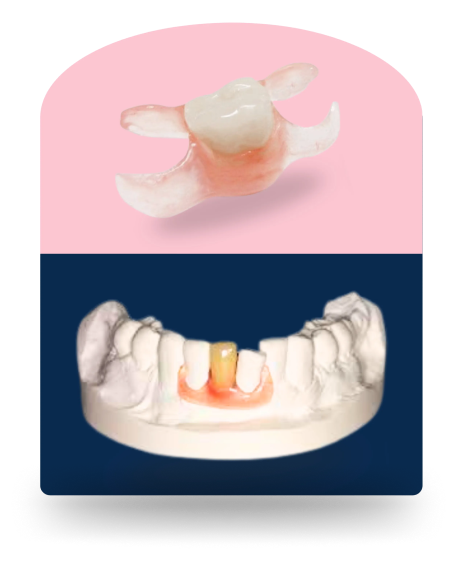Flexible Denture