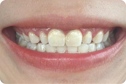 After Gingivectomy