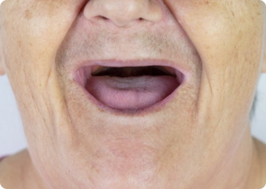 Who is a good candidate for dentures?