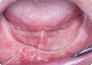 Who is a good candidate for dentures?