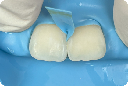 ICON Infiltration Treatment