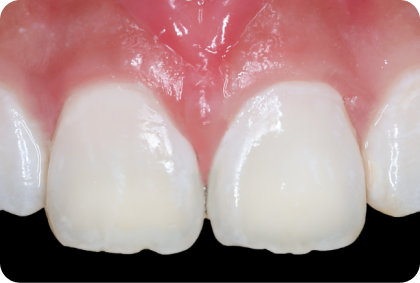 ICON Infiltration Treatment