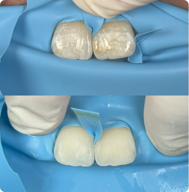 Patients with white spots Patients with white spots