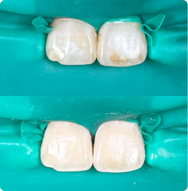 Mild surface discoloration Mild surface discoloration