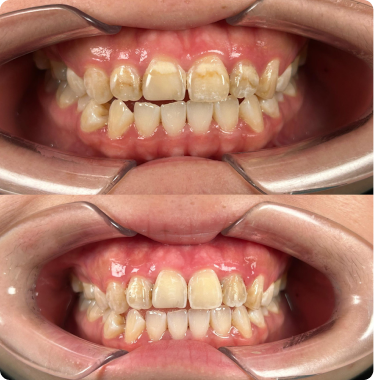 Fillings alternative Fillings alternative