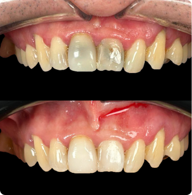 Have tooth discoloration Have tooth discoloration