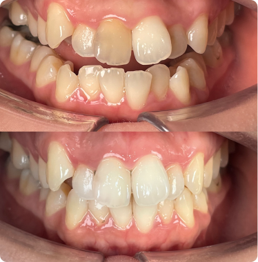 Generalized discoloration Generalized discoloration