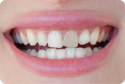 After Internal Bleaching