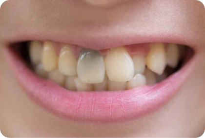 Before Internal Bleaching