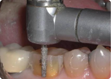 2nd Visit - Preparation + Impression