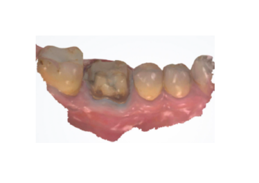 2nd Visit - Preparation + Impression