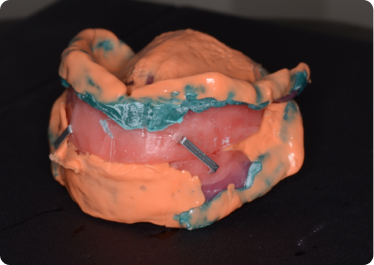 2nd Appointment - Secondary impression & bite record