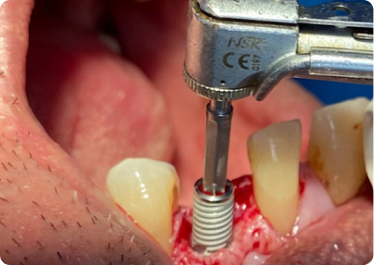 2nd Visit - Implant Placement Surgery