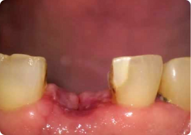 3rd Visit - Suture Removal