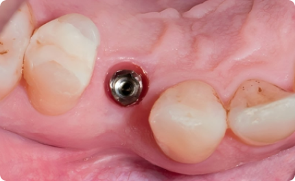 4th Visit - Implant Review