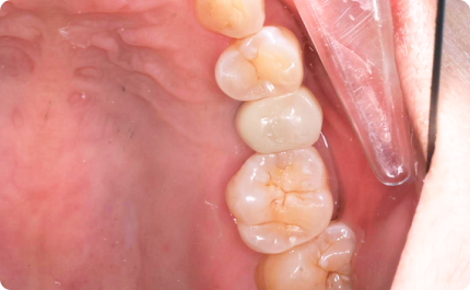 Following Visit - Crown Placement