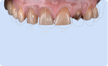 1st Appointment - Consultation & Smile Design 1st Appointment - Consultation & Smile Design