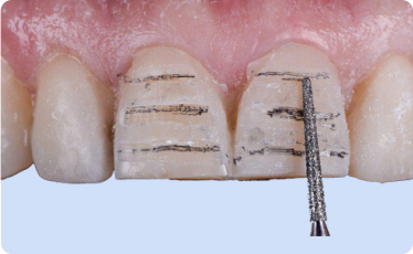 3rd Appointment - Tooth Preparation & Impression/Scans 3rd Appointment - Tooth Preparation & Impression/Scans