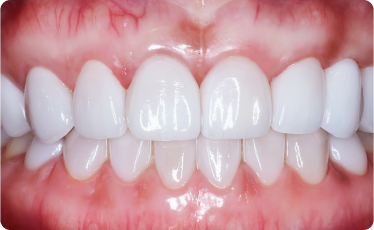 5th Appointment - Veneers Issue 5th Appointment - Veneers Issue