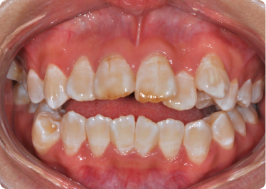 2nd Appointment - Pre-orthodontic treatment 2nd Appointment - Pre-orthodontic treatment