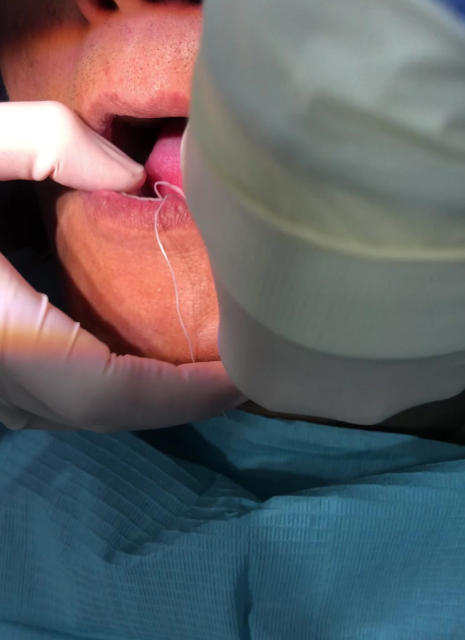 Suction Denture: A case with History of Failed Implant-Supported Prosthesis