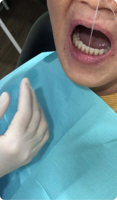Another suction denture testimonies