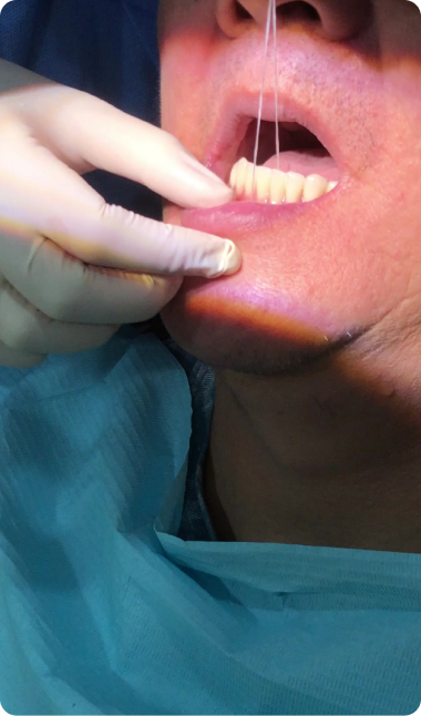 Another suction denture testimonies