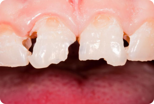 Why Aesthetic Filling? Why Aesthetic Filling?