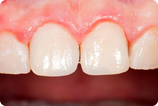 Why Aesthetic Filling? Why Aesthetic Filling?