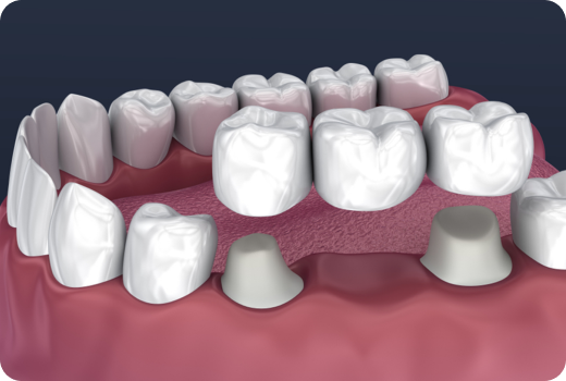 Why Crowns and Bridges?