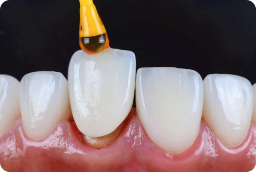 Why Crowns and Bridges?