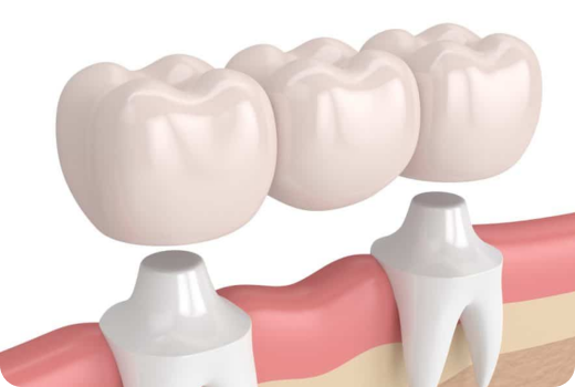 Why Crowns and Bridges?