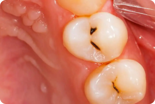 Why Filling? Why Filling?