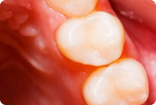 Why Filling? Why Filling?