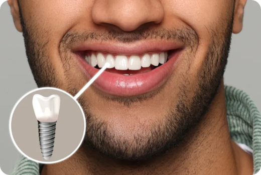 Why Implants?