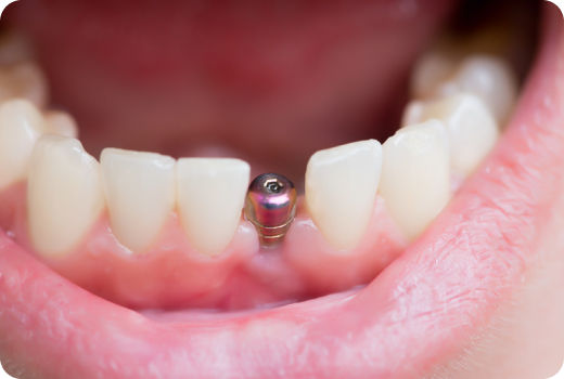Why Implants?