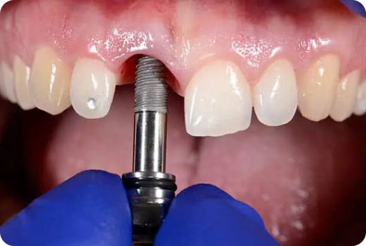 Why Implants?