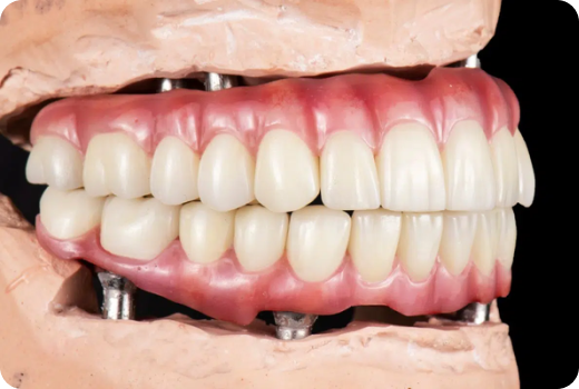 Why Implants?