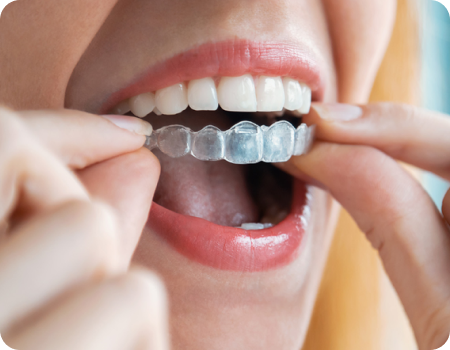 Why Invisalign? Why Invisalign?