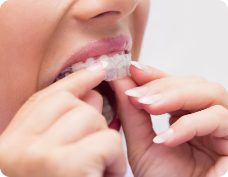 Why Invisalign? Why Invisalign?